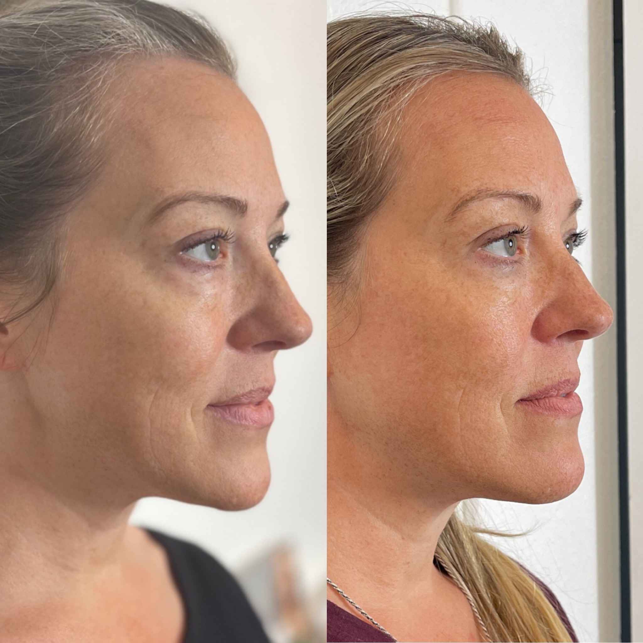 Before and After Bio Stimulator Treatment | Onyx Medical Aesthetics | Homann Dr. S.E. suite B Lacey, WA