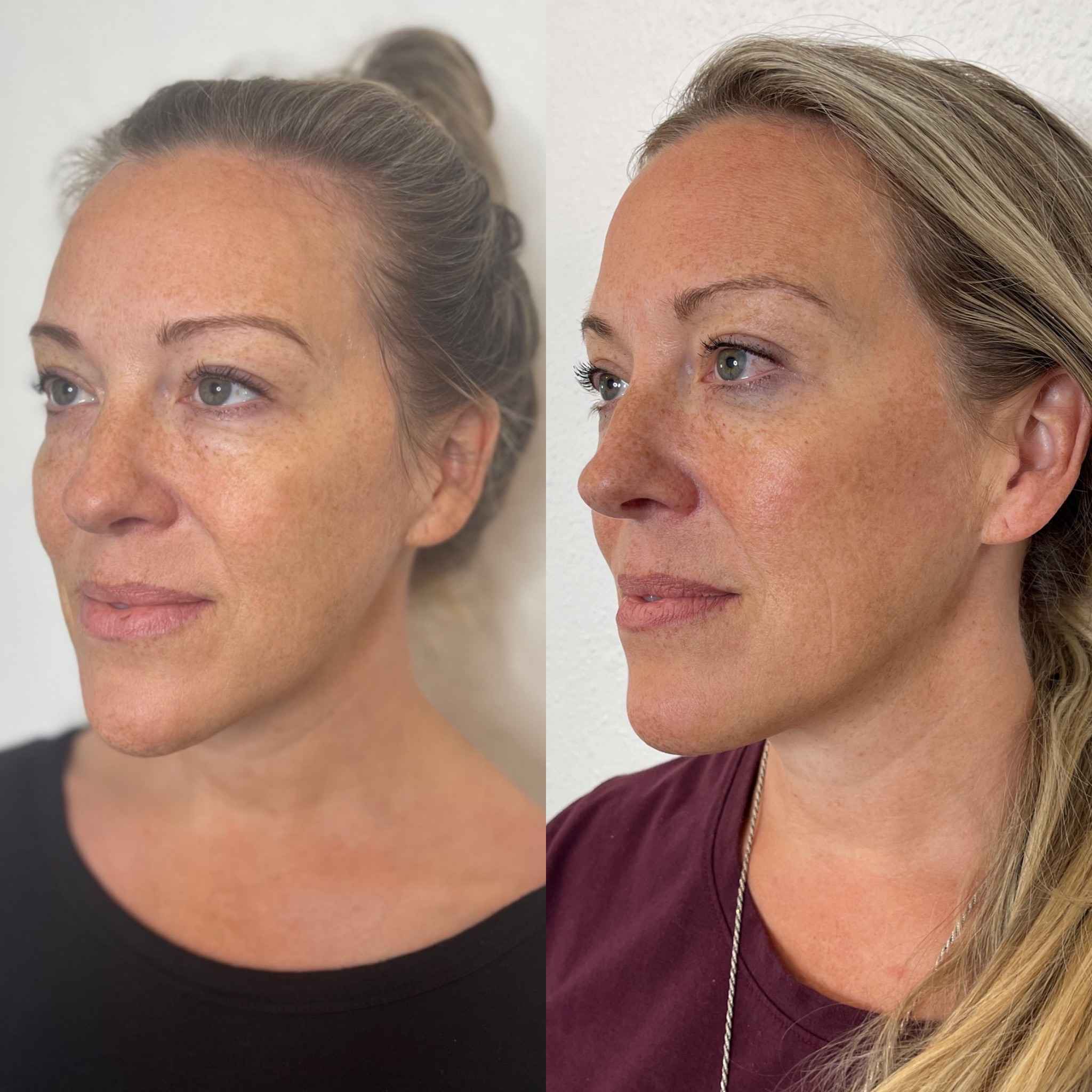 Before and After Changes in Face After Bio Stimulator Treatment | Onyx Medical Aesthetics | Homann Dr. S.E. suite B Lacey, WA