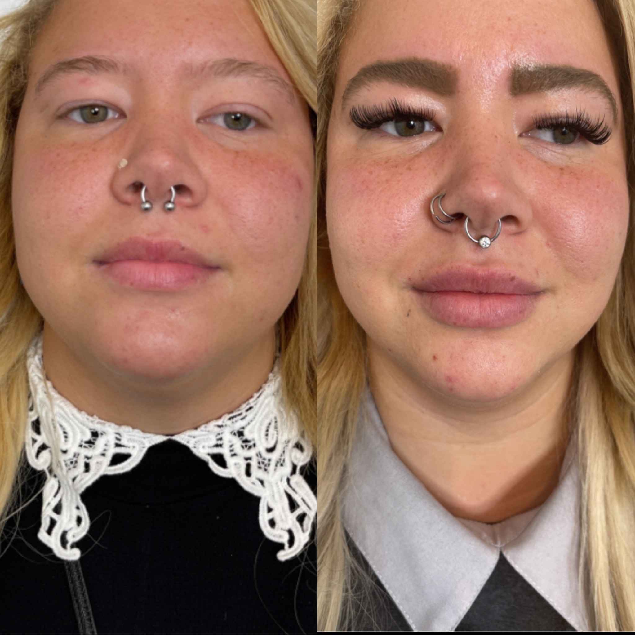 Result of Face Before and After Filler Treatment | Onyx Medical Aesthetics | Homann Dr. S.E. suite B Lacey, WA