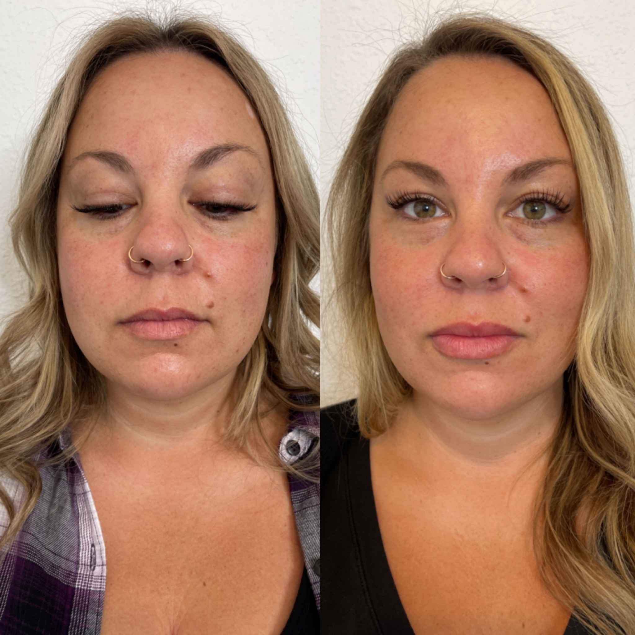 Before and After Filler Treatment | Onyx Medical Aesthetics | Homann Dr. S.E. suite B Lacey, WA