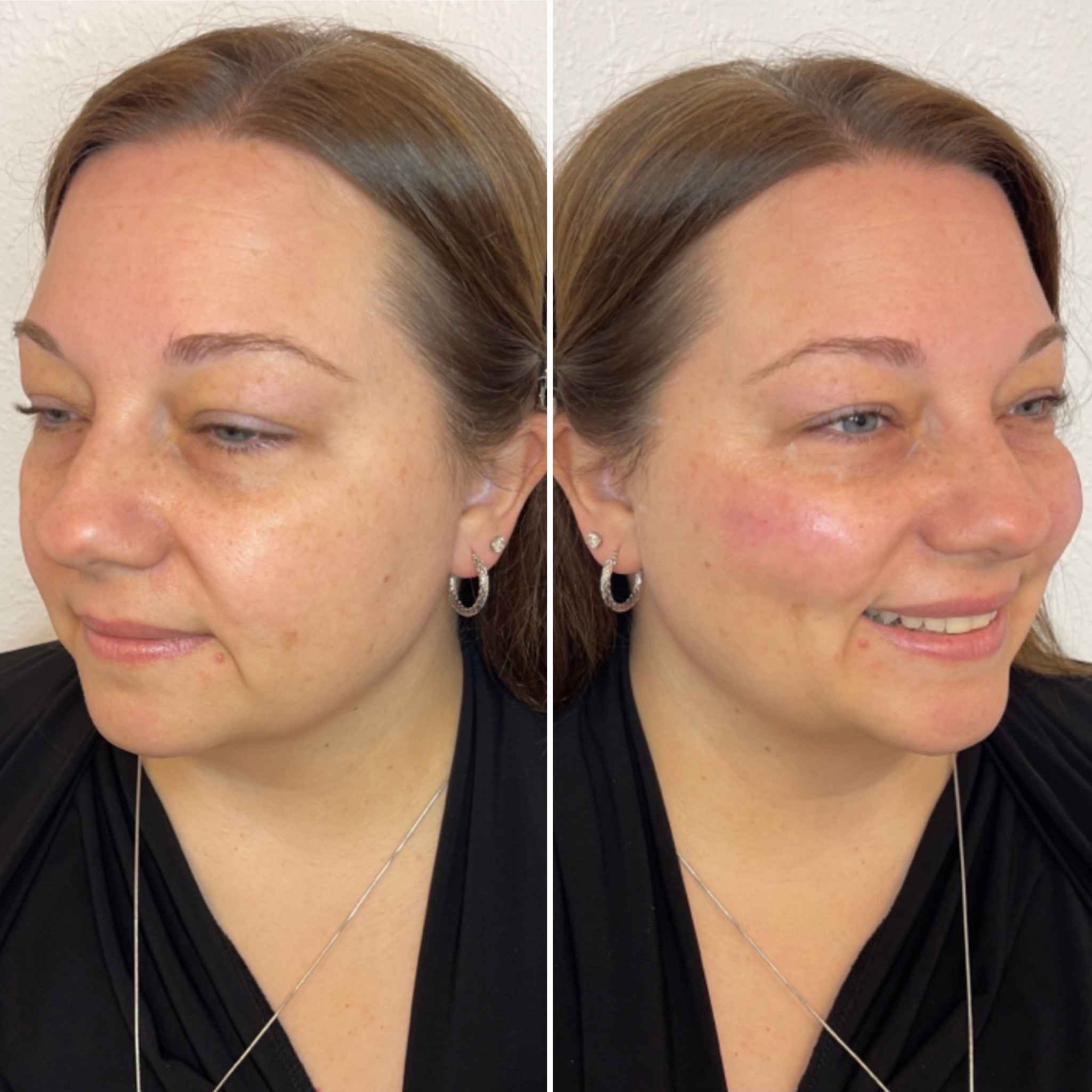 Smiley Face After Cheek Filler Treatment | Onyx Medical Aesthetics | Homann Dr. S.E. suite B Lacey, WA