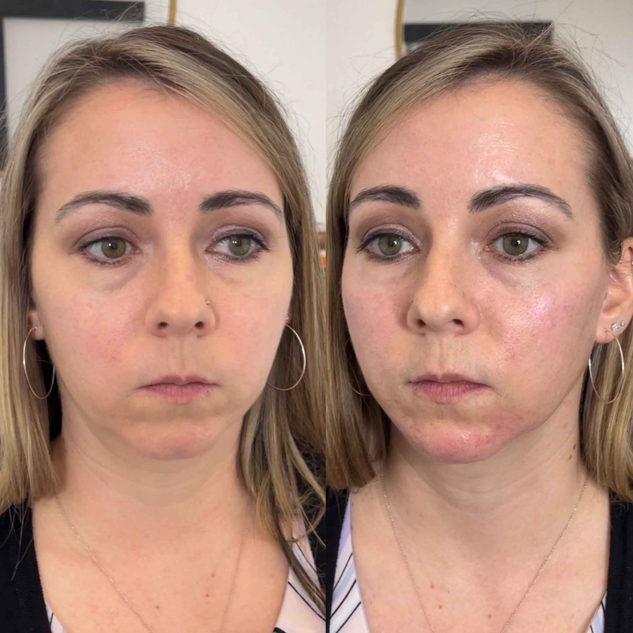 Before and After Cheek Filler Treatment | Onyx Medical Aesthetics | Homann Dr. S.E. suite B Lacey, WA