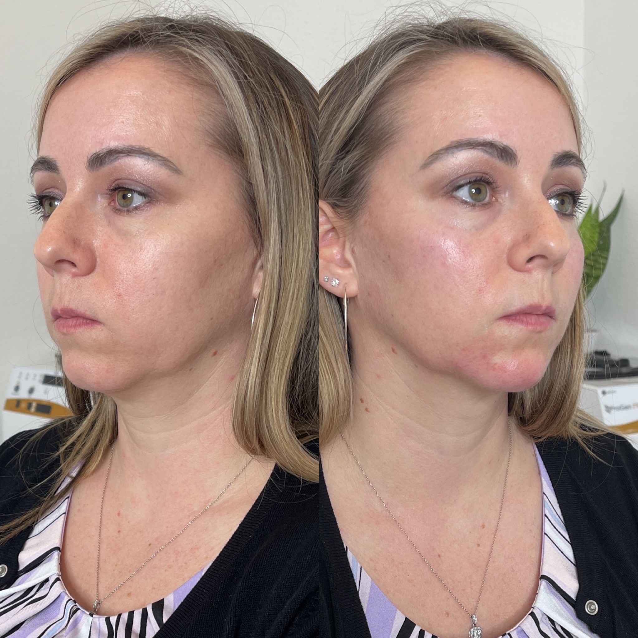 Chin Lower Face Filler Before and After Treatment | Onyx Medical Aesthetics | Homann Dr. S.E. suite B Lacey, WA