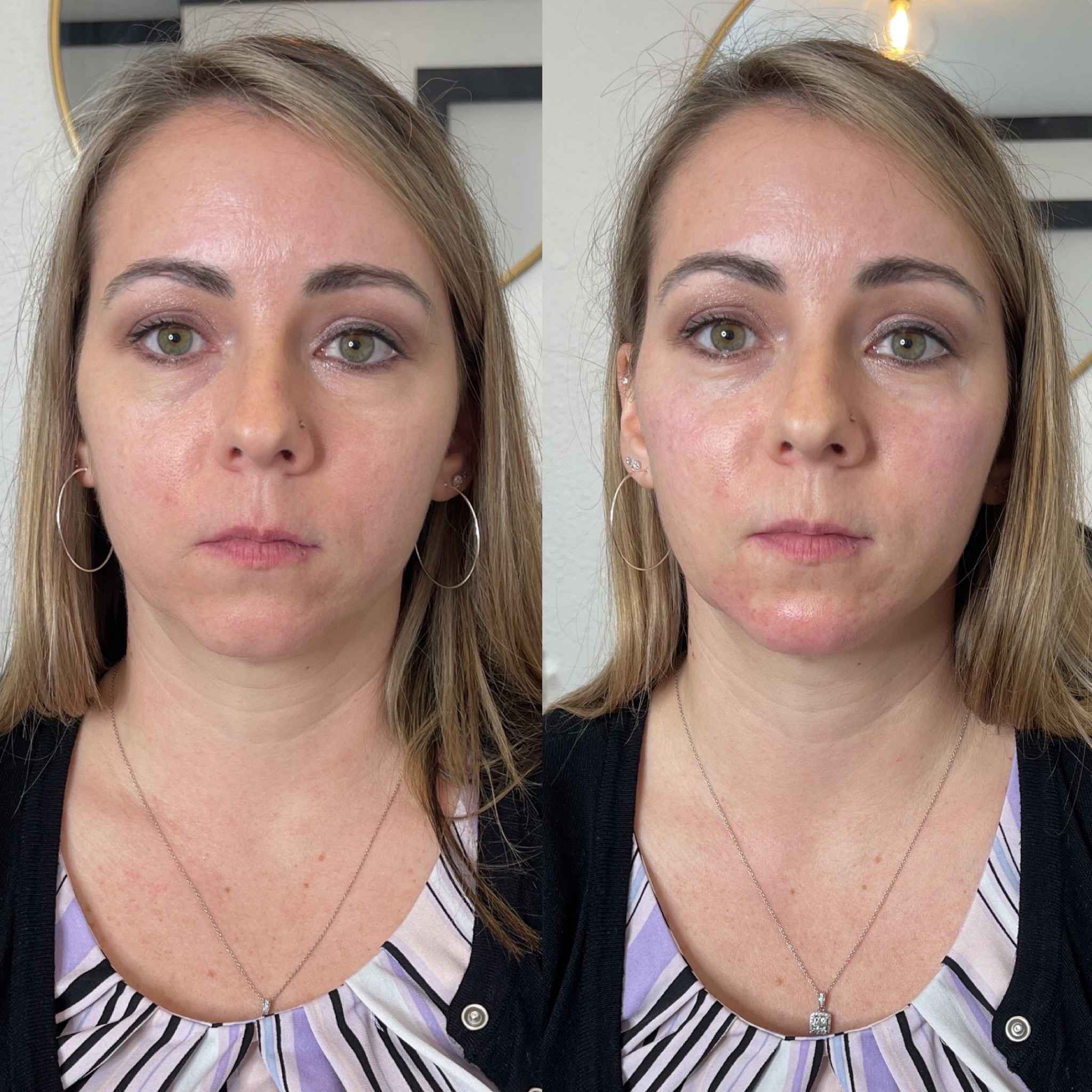 Before and After Chin Lower Face Filler treatment | Onyx Medical Aesthetics | Homann Dr. S.E. suite B Lacey, WA