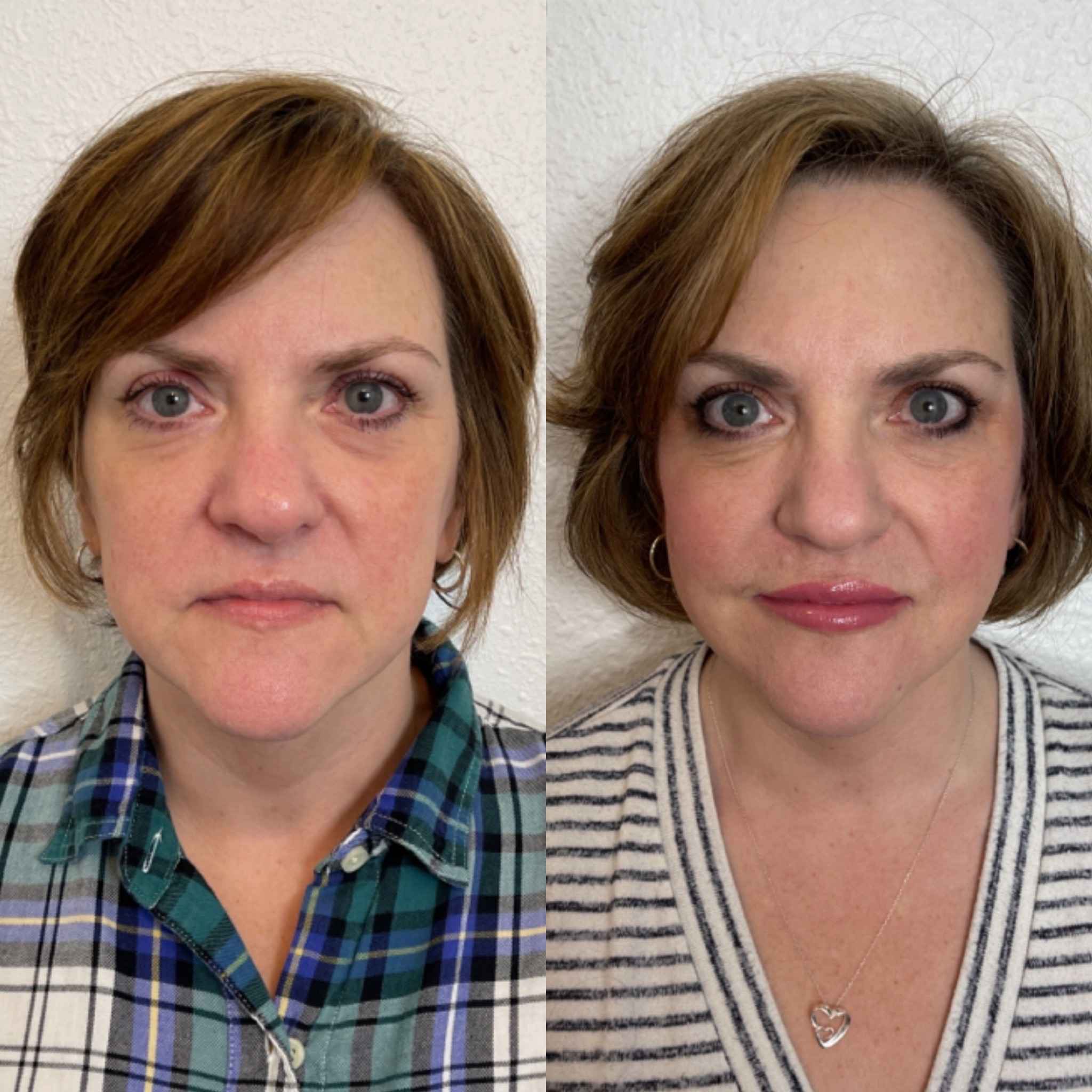 Before and After Full Face Rejuvenation Treatment | Onyx Medical Aesthetics | Homann Dr. S.E. suite B Lacey, WA