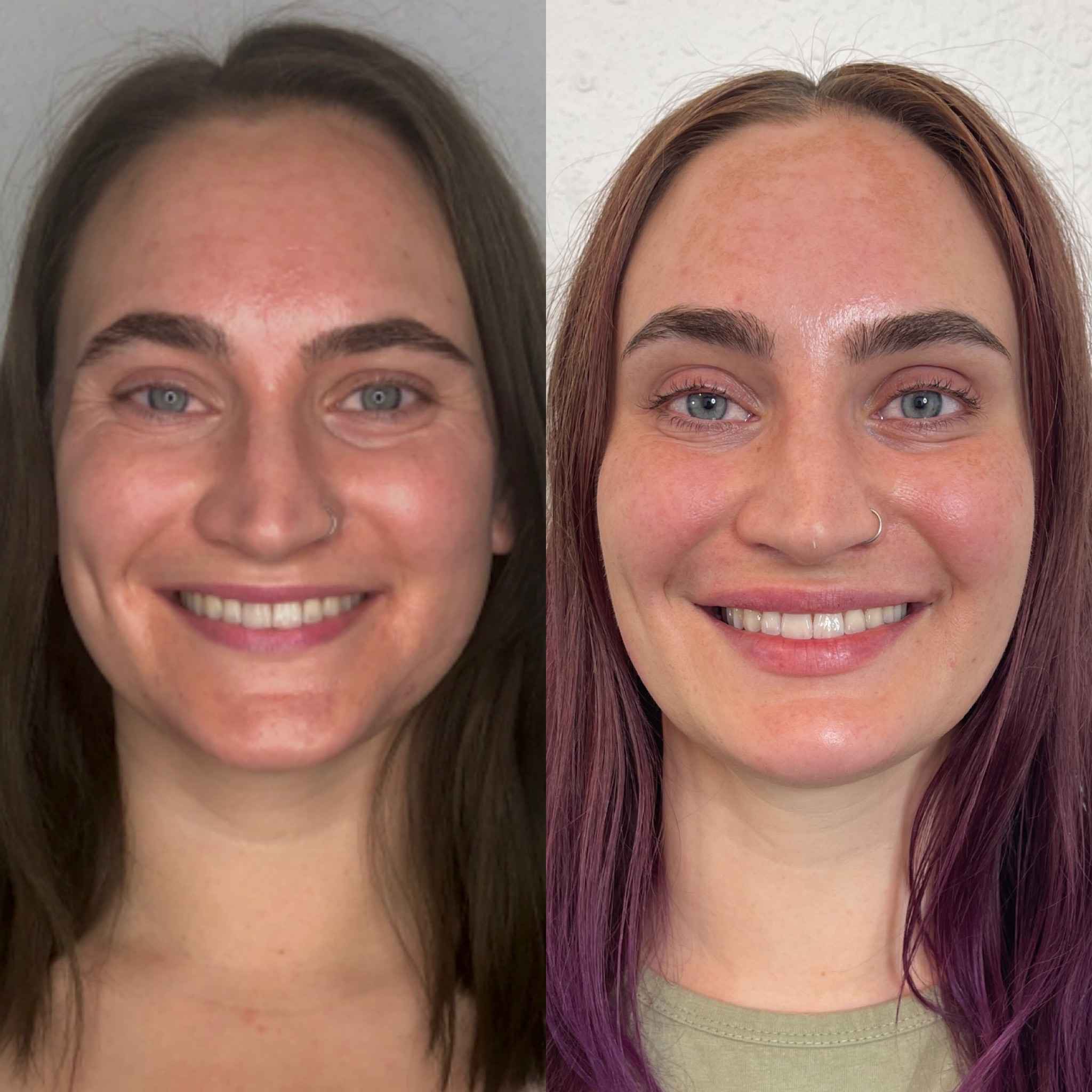 Smiley Face After Full Face Rejuvenation Treatment | Onyx Medical Aesthetics | Homann Dr. S.E. suite B Lacey, WA