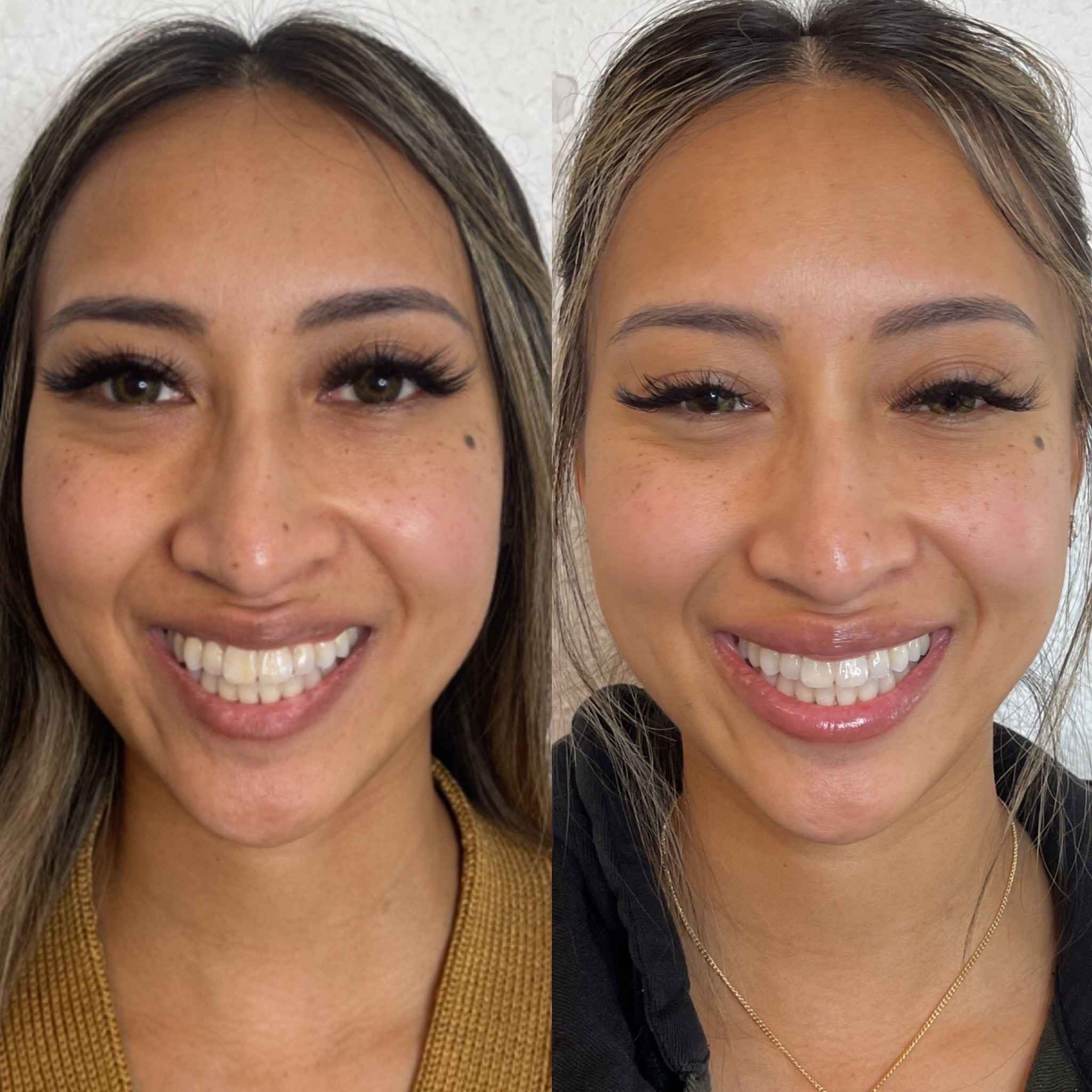 Before and After Fillers Treatment | Onyx Medical Aesthetics | Homann Dr. S.E. suite B Lacey, WA