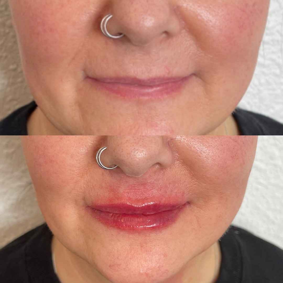 Before and After Lip Treatment Fillers | Onyx Medical Aesthetics | Homann Dr. S.E. suite B Lacey, WA