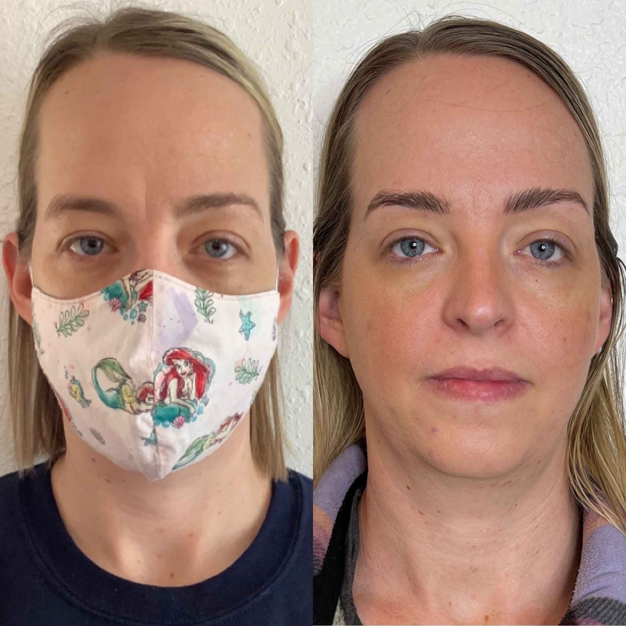 Before and After Wrinkle Relaxer Treatment | Onyx Medical Aesthetics | Homann Dr. S.E. suite B Lacey, WA