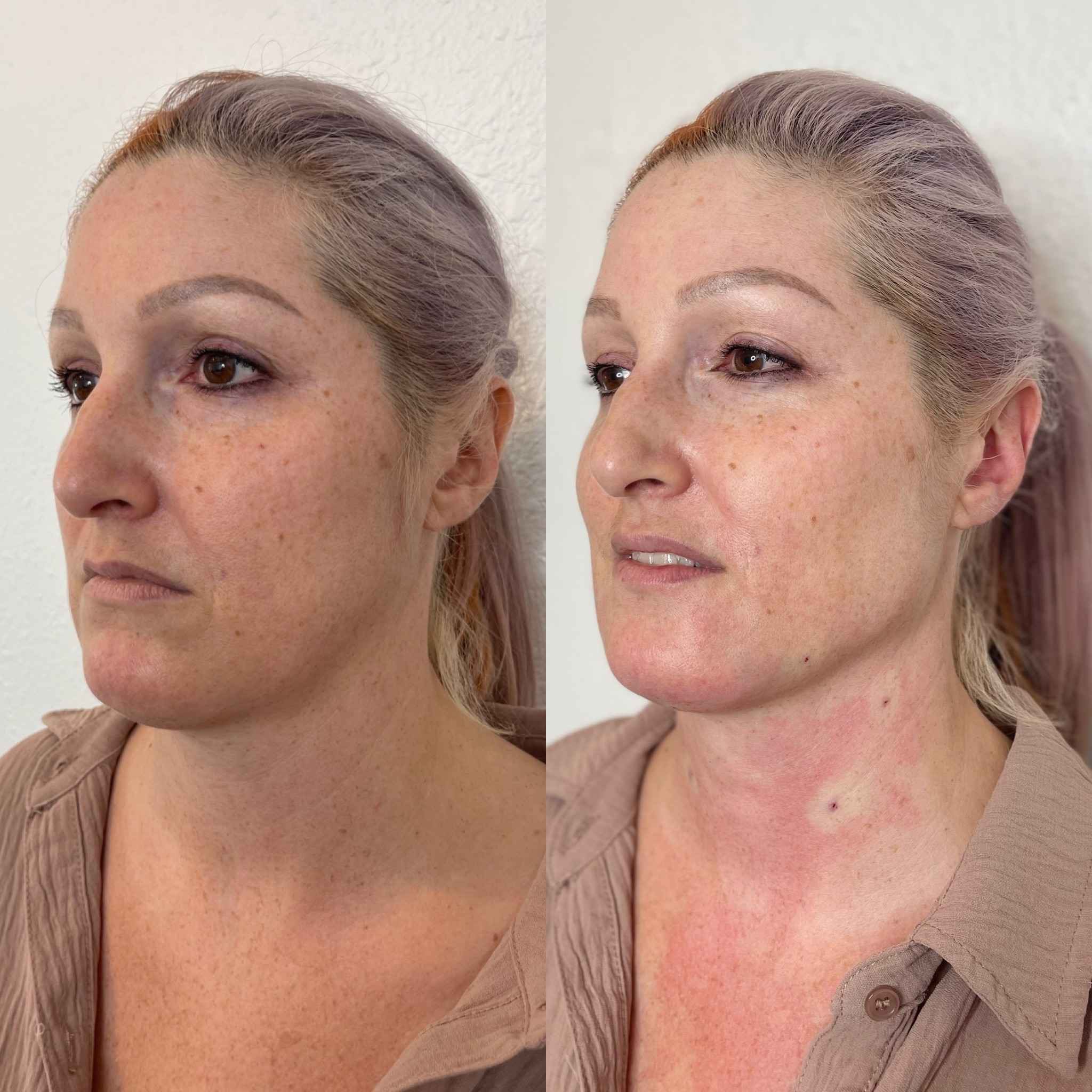 Before and After Bio Stimulator | Onyx Medical Aesthetics | Homann Dr. S.E. suite B Lacey, WA