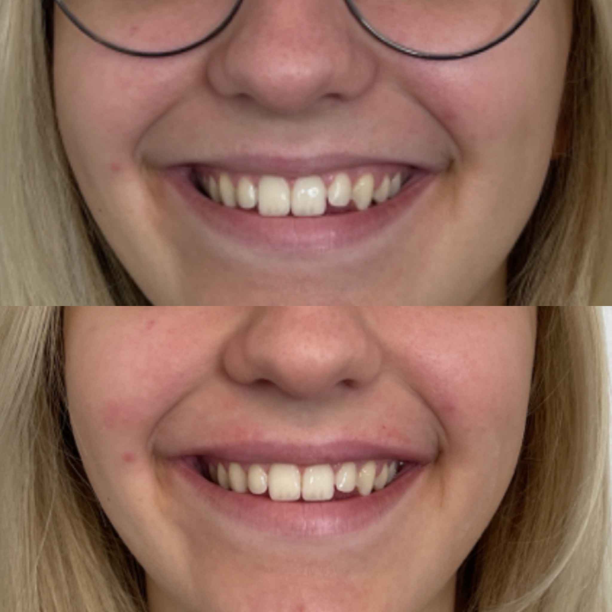 Smile Before and After Fillers Treatment | Onyx Medical Aesthetics | Homann Dr. S.E. suite B Lacey, WA