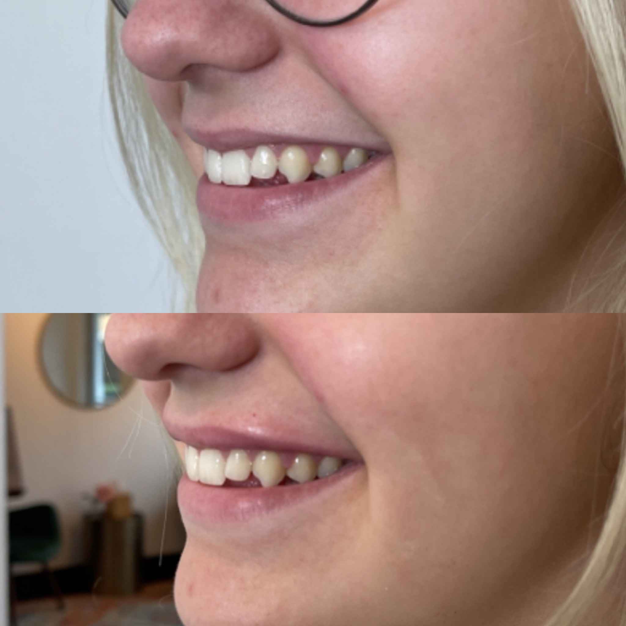Before & After Fillers Treatment Results in Smile | Onyx Medical Aesthetics | Homann Dr. S.E. suite B Lacey, WA