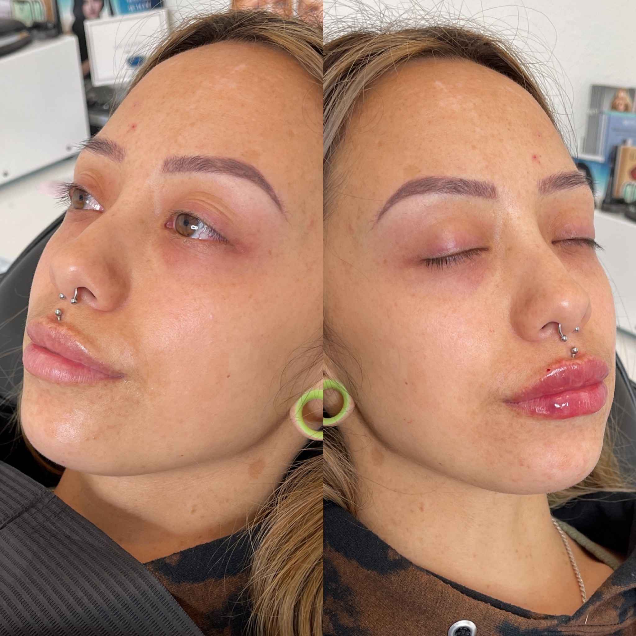 Before and After Lip Treatment | Onyx Medical Aesthetics | Homann Dr. S.E. suite B Lacey, WA