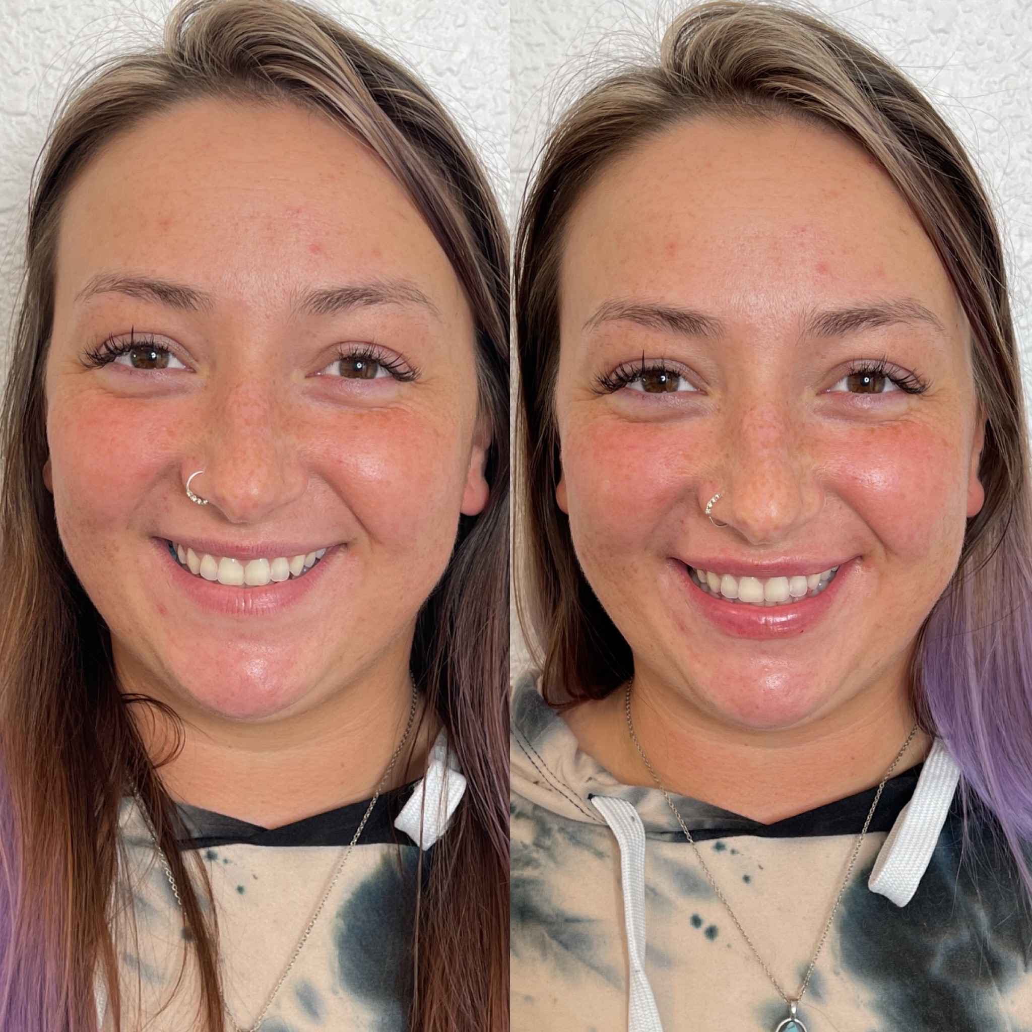 Result of Before and After Fillers Treatment | Onyx Medical Aesthetics | Homann Dr. S.E. suite B Lacey, WA