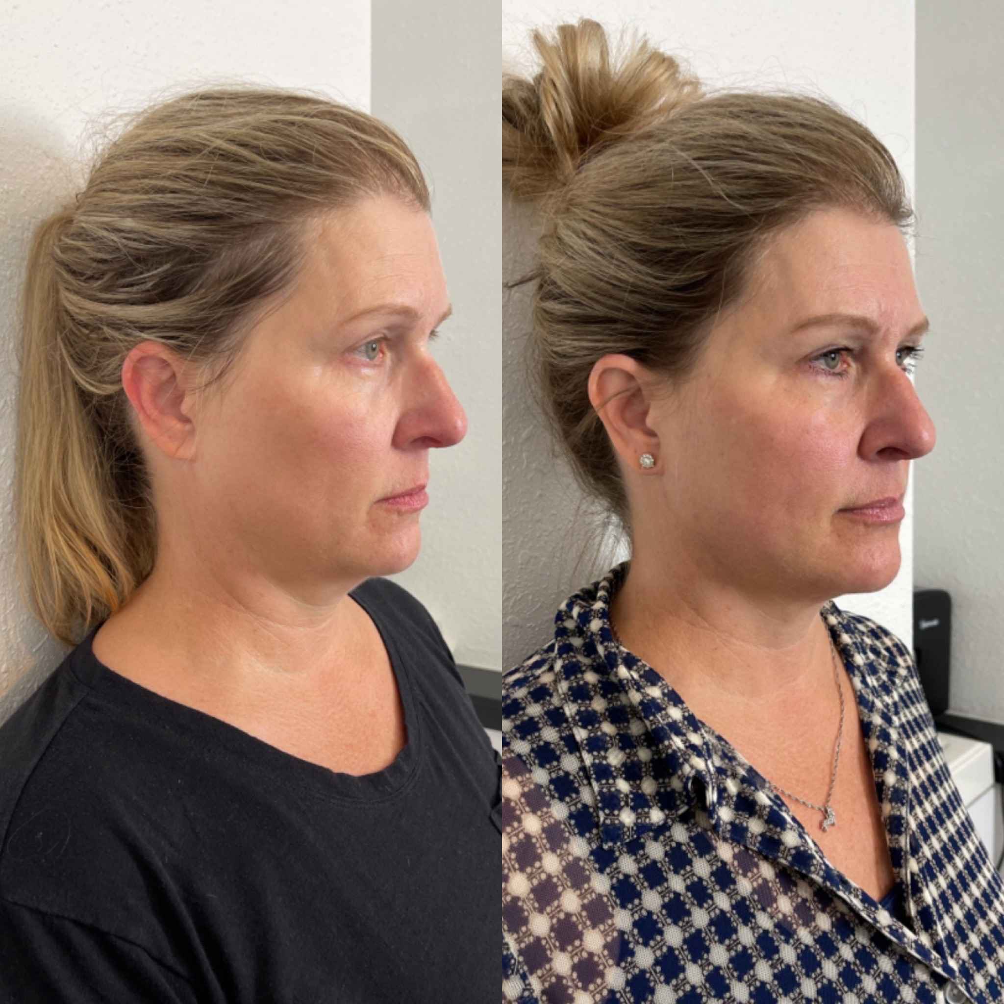 Before and After Changes by PDO Threads treatment | Onyx Medical Aesthetics | Homann Dr. S.E. suite B Lacey, WA