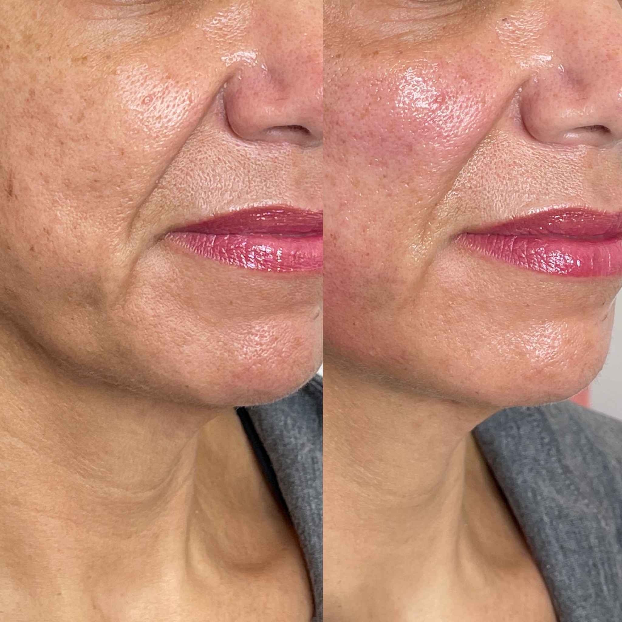 Before and After PDO Threads Treatment Result | Onyx Medical Aesthetics | Homann Dr. S.E. suite B Lacey, WA