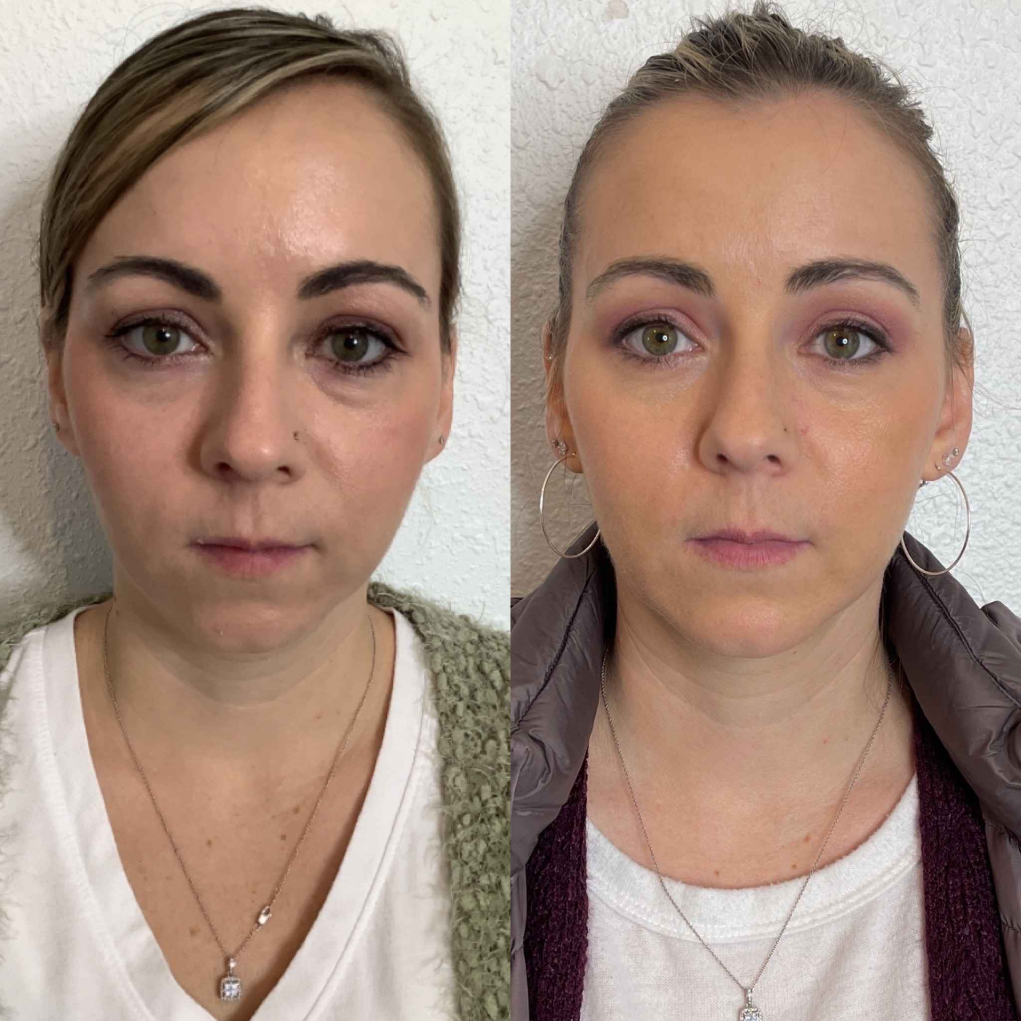 Before and After Changes by PDO Threads Treatment | Onyx Medical Aesthetics | Homann Dr. S.E. suite B Lacey, WA