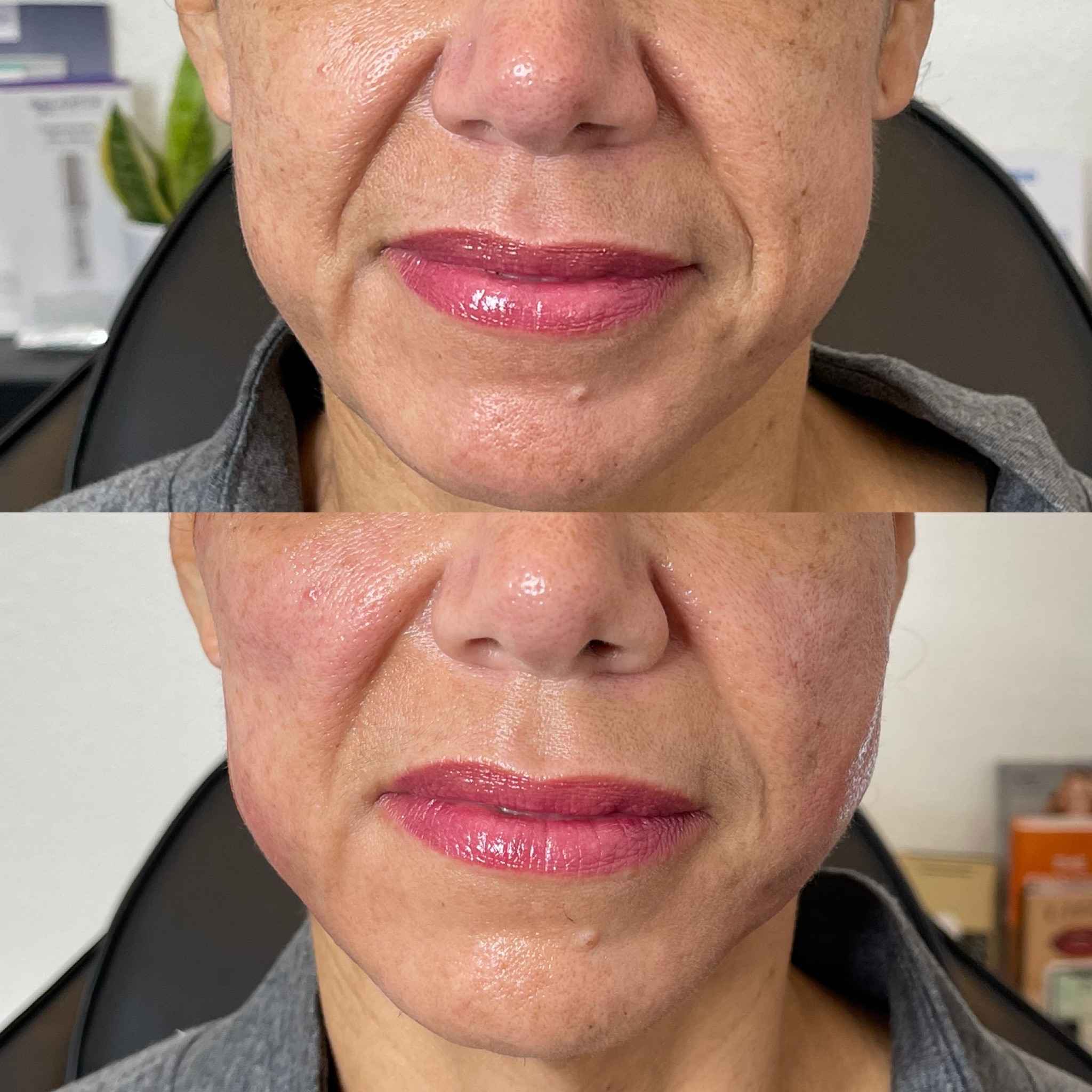 Before and After Result of PDO Threads treatment | Onyx Medical Aesthetics | Homann Dr. S.E. suite B Lacey, WA