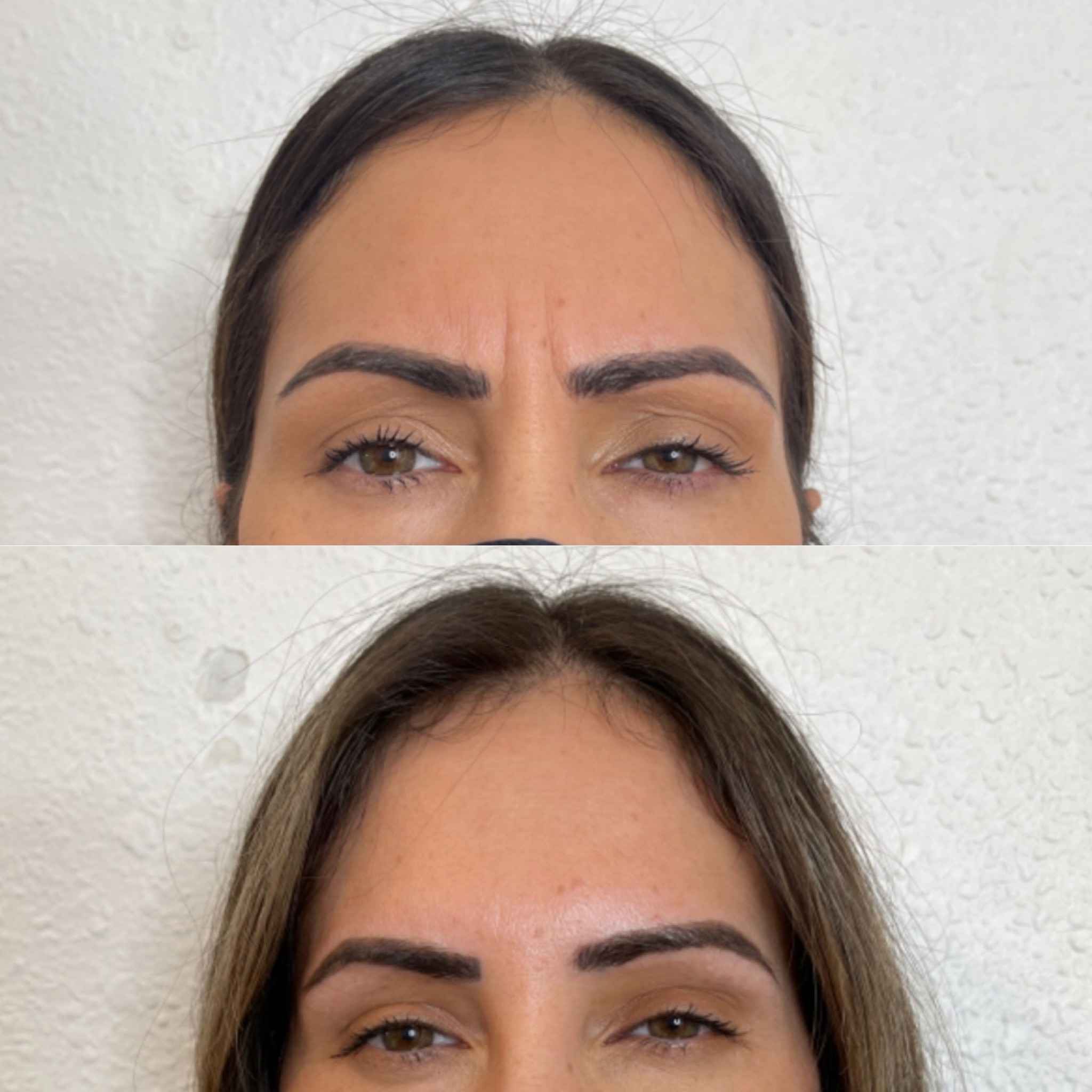 Before and After Wrinkle Relaxer Treatment to Forehead | Onyx Medical Aesthetics | Homann Dr. S.E. suite B Lacey, WA