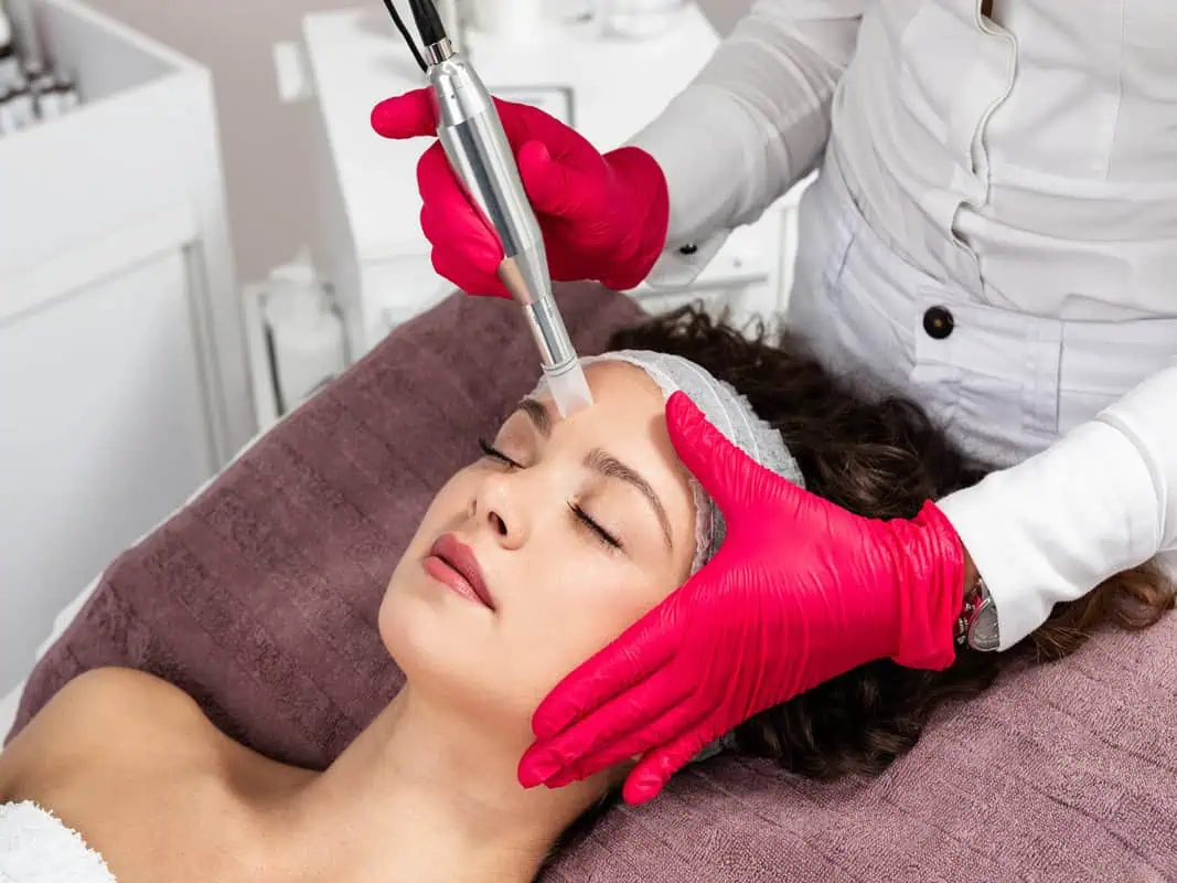 microneedling by onyxmedicalaestheticsspa in united states