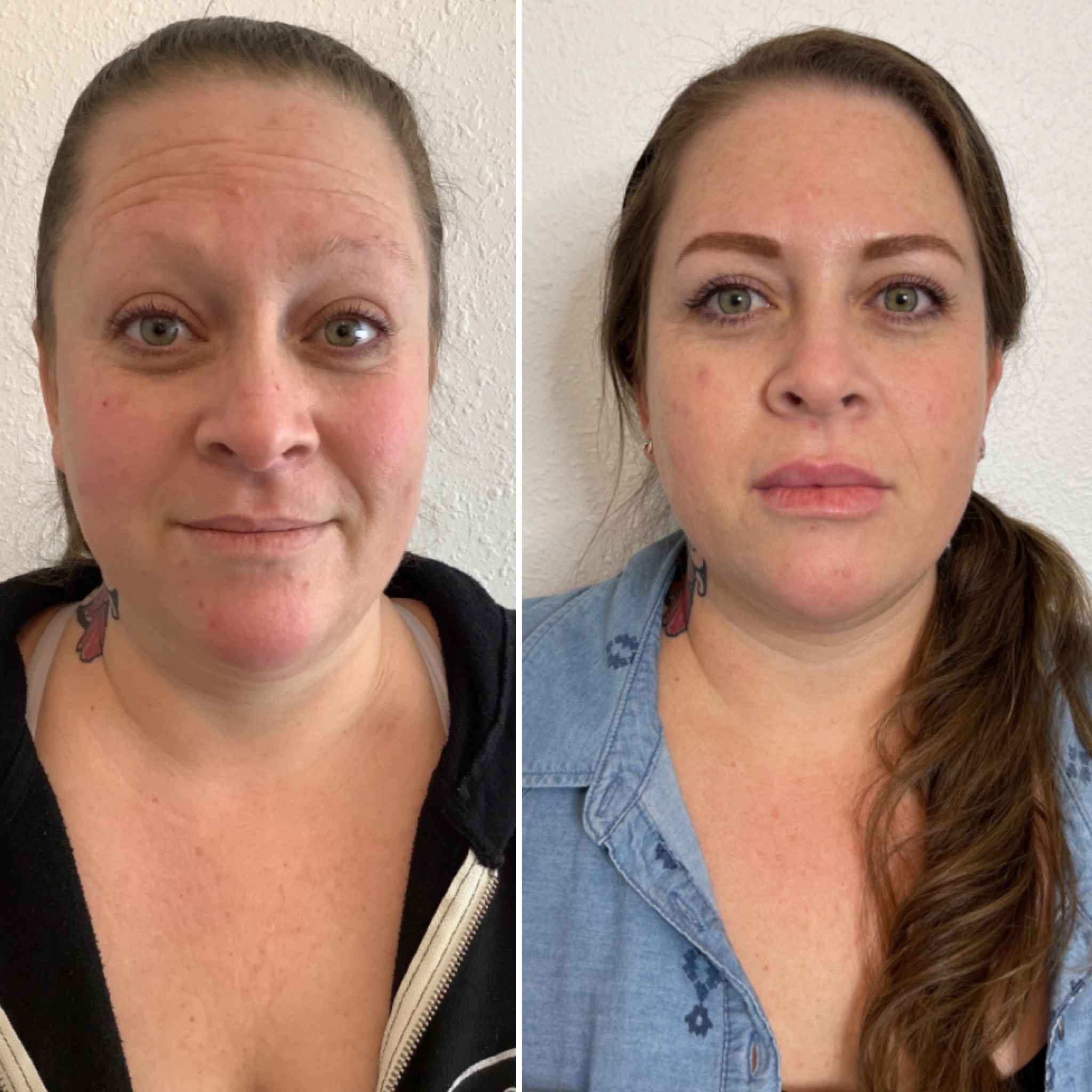 Med Spa Before and After Photos | Onyx Medical Aesthetics WA